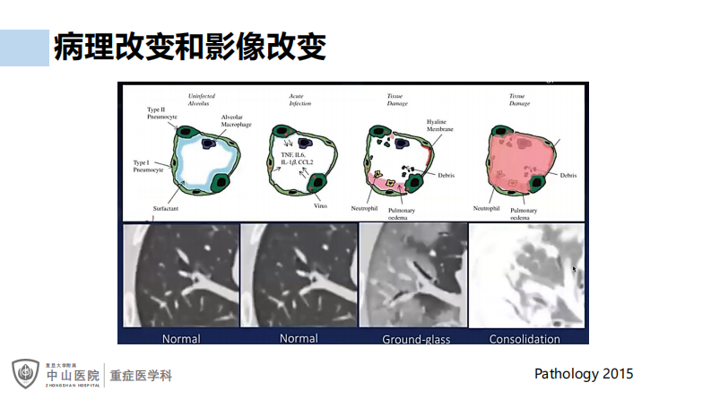 罗哲：COVID19治疗和AI-CT.pdf 第5页