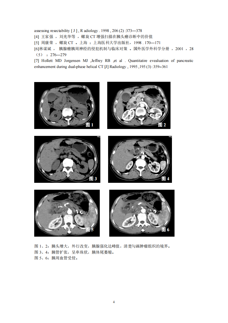 沈宣文多排螺旋CT双期扫描对胰腺癌的诊断价值.pdf 第4页