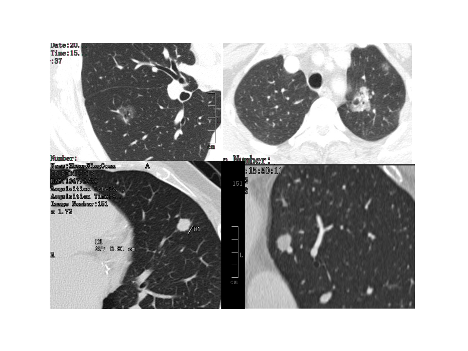 肺结节的应对策略.pptx 第3页