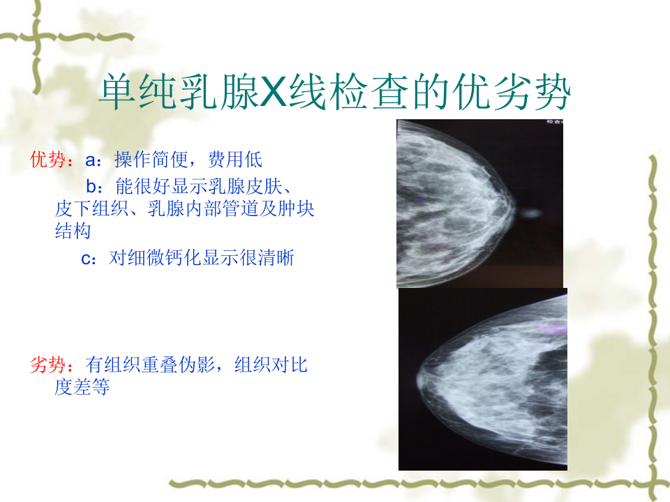 乳腺癌MRI诊断.ppt 第4页