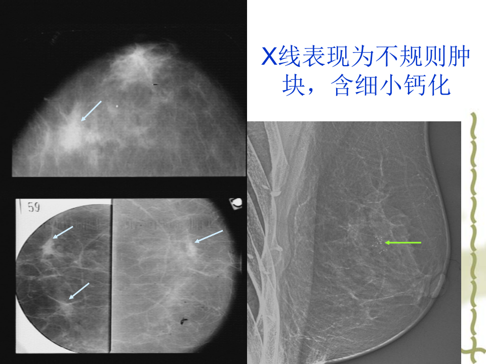 乳腺癌MRI诊断.ppt 第5页