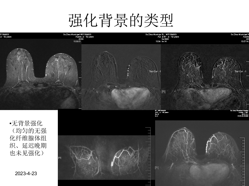 乳腺磁共振规范诊断解读.ppt 第4页