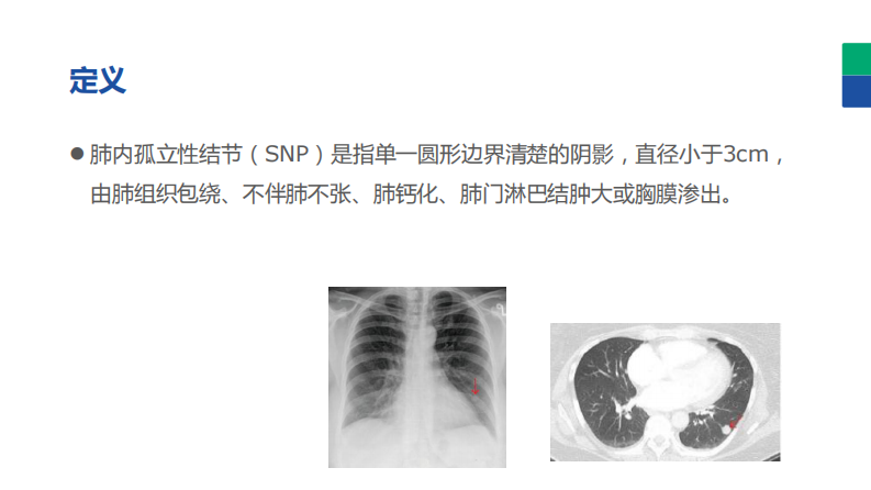 《肺部孤立性结节的CT诊断》.pdf 第3页