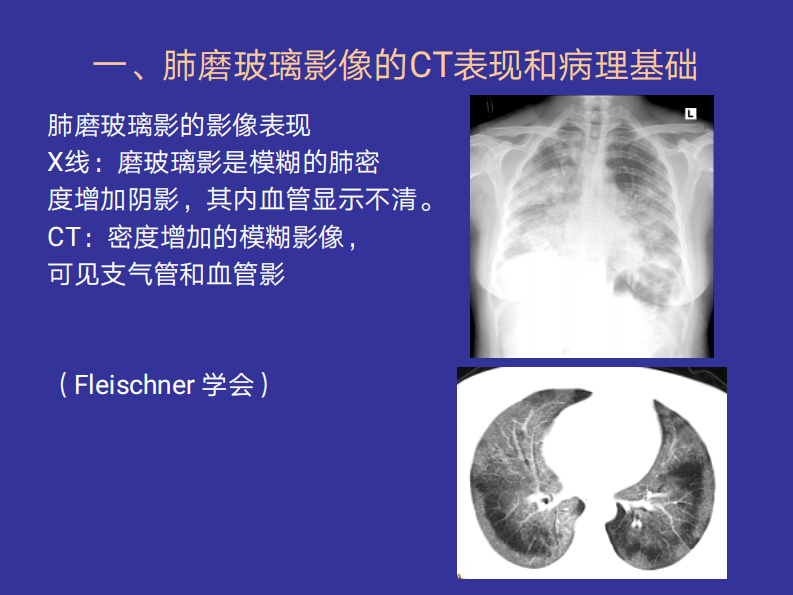 2019年4月21日肺弥漫磨玻璃影的CT.pdf 第2页