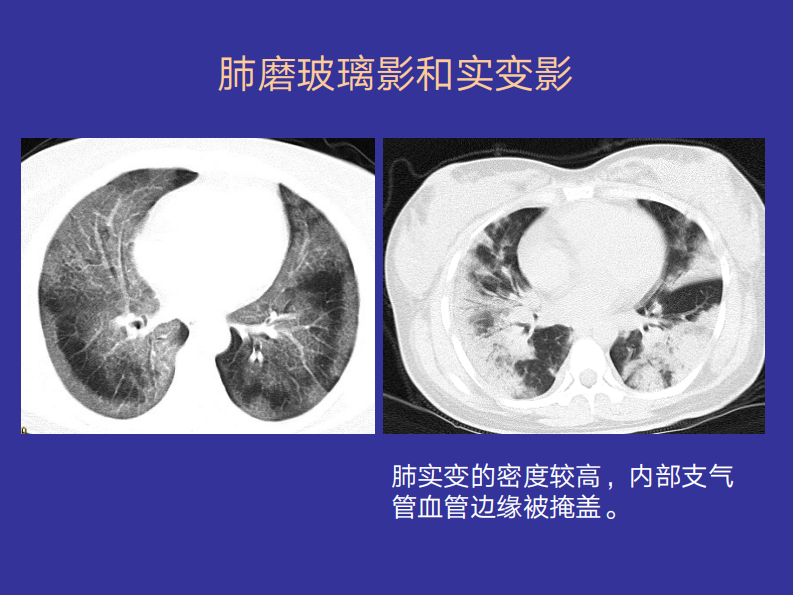 2019年4月21日肺弥漫磨玻璃影的CT.pdf 第3页