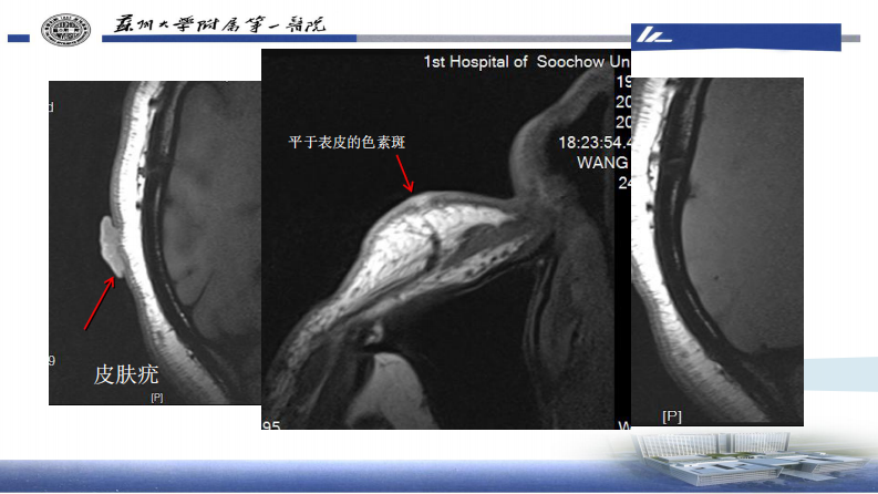 皮肤肿瘤HRMRI成像—李勇刚.pdf 第4页