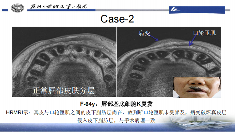 皮肤肿瘤HRMRI成像—李勇刚.pdf 第3页