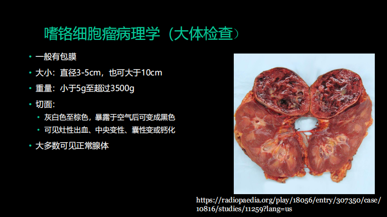 肾上腺嗜铬细胞瘤影像诊断及鉴别诊断—邢伟.pdf 第5页