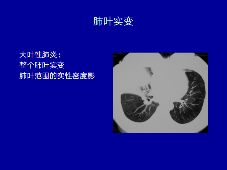 细菌性肺炎的影像诊断2019.pdf 第5页