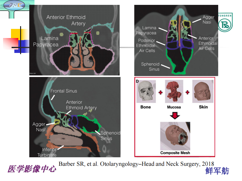 额隐窝及解剖变异与意义--鲜军舫.pdf 第3页
