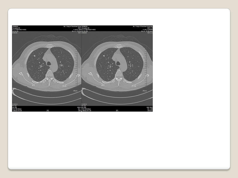 磨玻璃结节的影像分析--郭亮.pdf 第3页