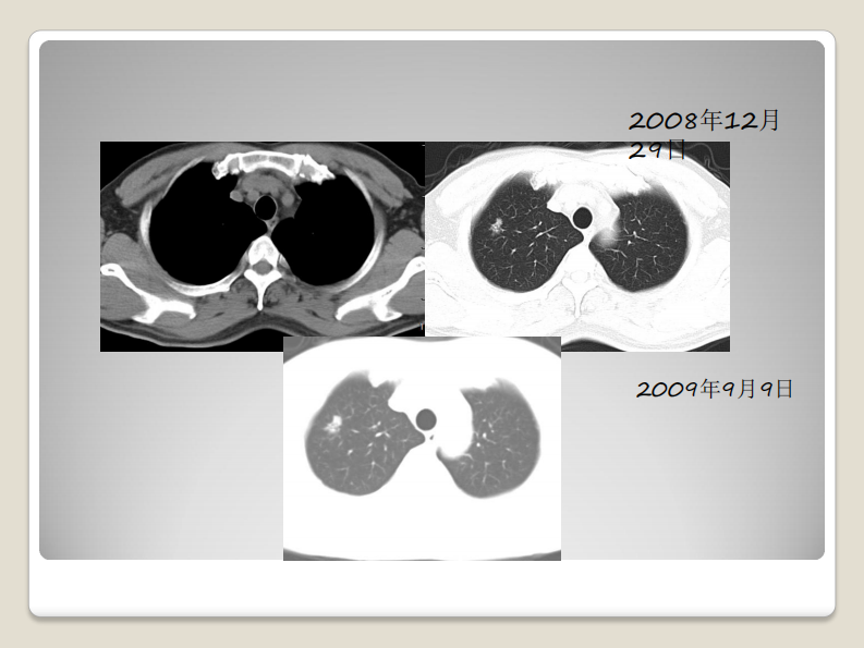 磨玻璃结节的影像分析--郭亮.pdf 第5页