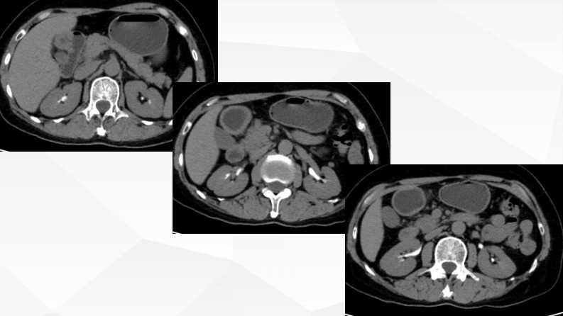 胰腺富血供占位诊断及鉴别诊断--张欢.pdf 第4页
