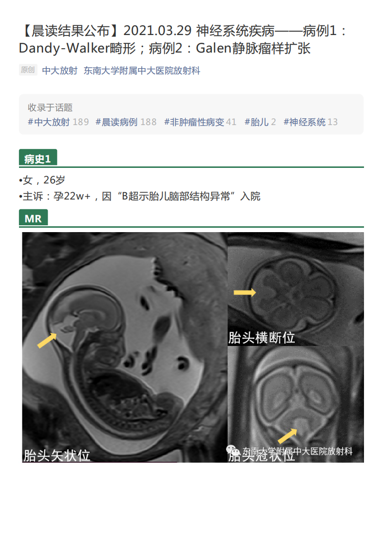 20210329_2【晨读结果公布】2021.03.29神经系统疾病——病例1：Dandy-Walker畸形；病例2：Galen静脉瘤样扩张.pdf 第1页