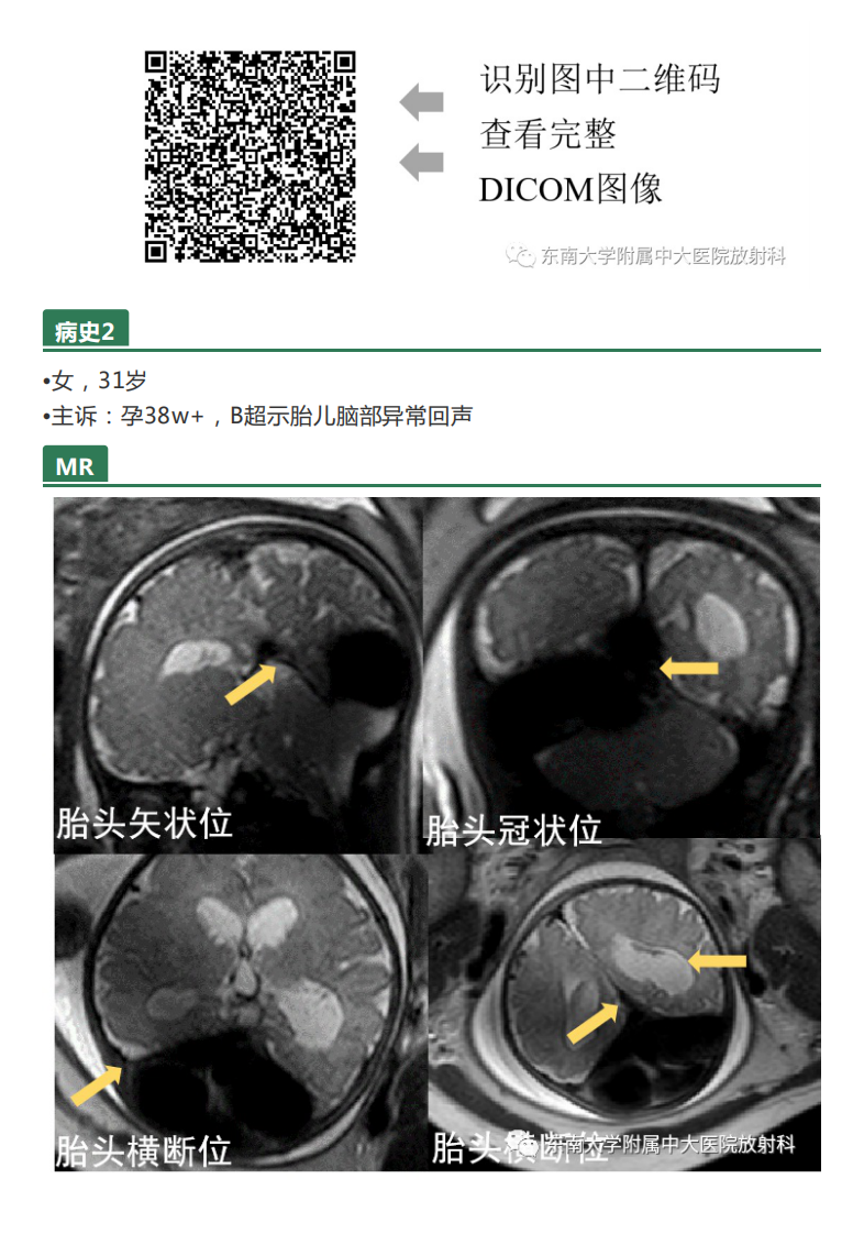 20210329_2【晨读结果公布】2021.03.29神经系统疾病——病例1：Dandy-Walker畸形；病例2：Galen静脉瘤样扩张.pdf 第2页