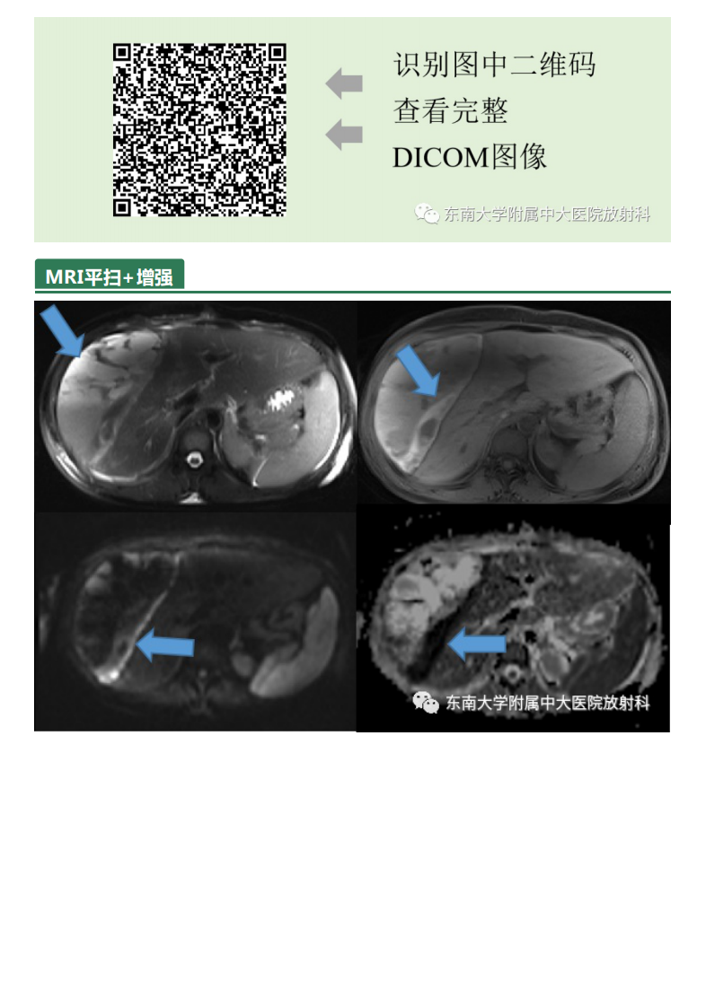 20210621_3【晨读结果公布】2021.06.21消化系统疾病——病例1HELLP；病例2：ANCA相关性血管炎；病例3：原发性肝癌.pdf 第3页
