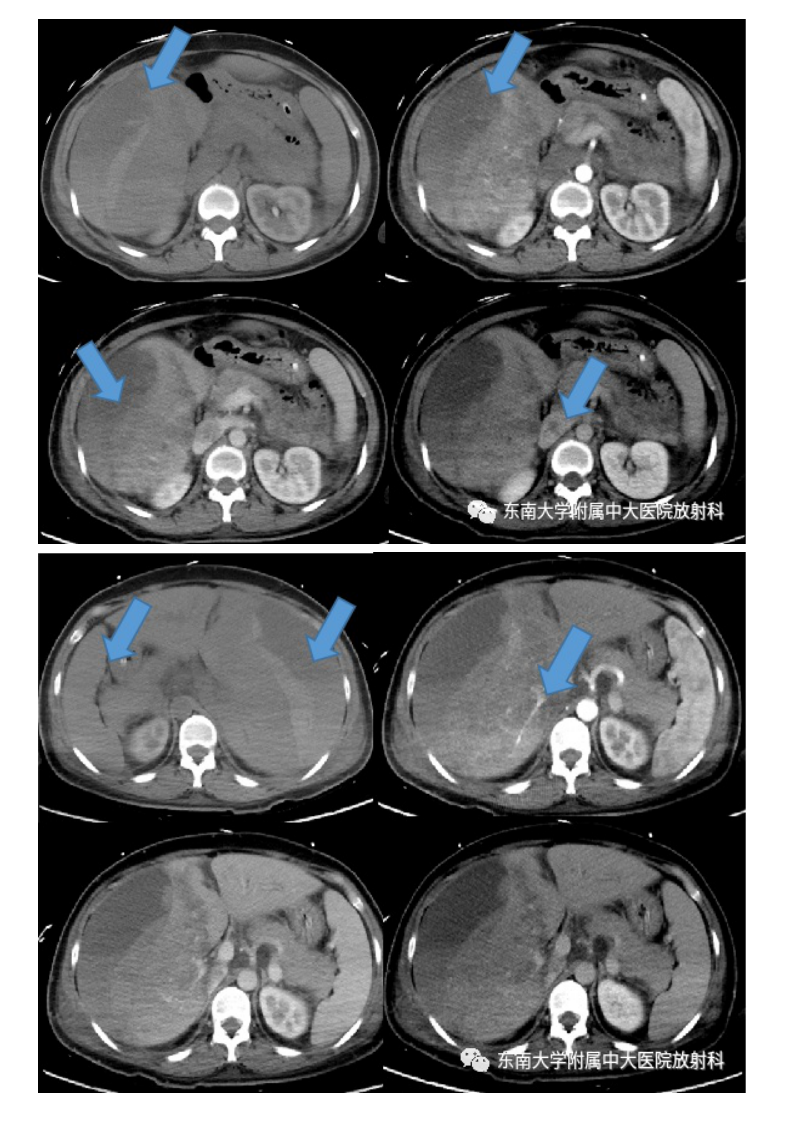20210621_3【晨读结果公布】2021.06.21消化系统疾病——病例1HELLP；病例2：ANCA相关性血管炎；病例3：原发性肝癌.pdf 第2页