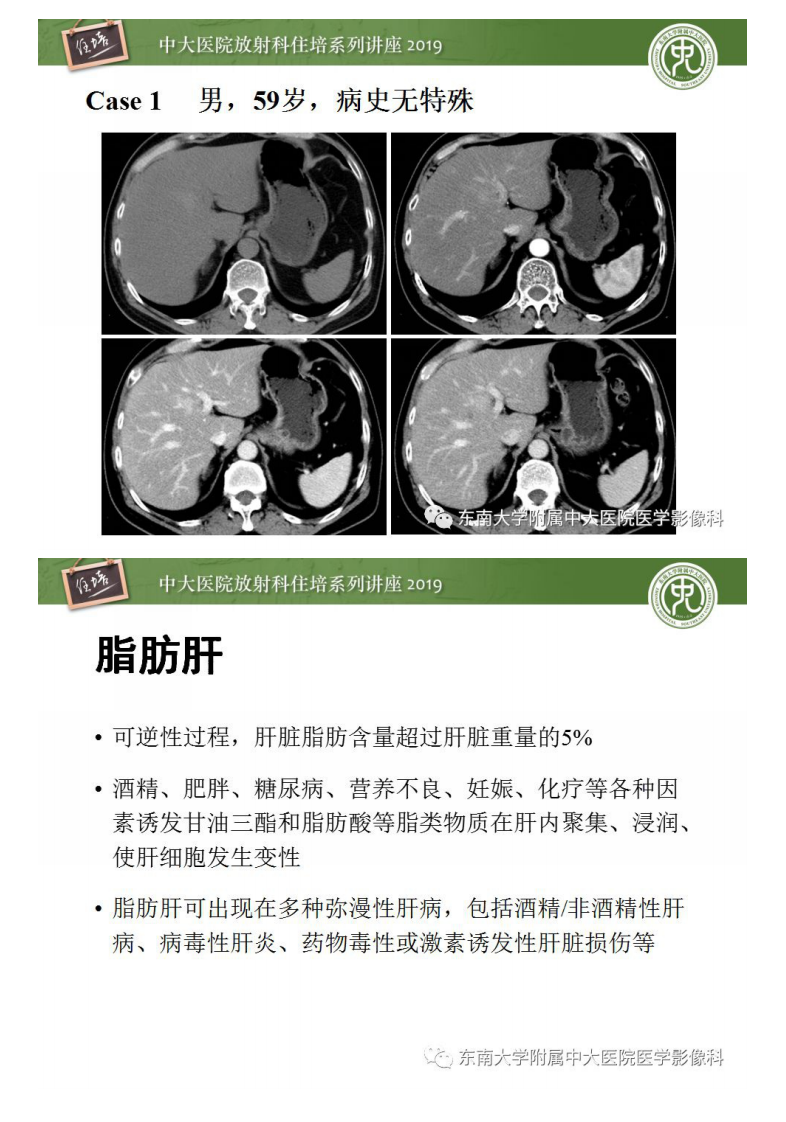 20200211_1【中大放射住培系列讲座】肝脏弥漫性病变影像表现.pdf 第3页