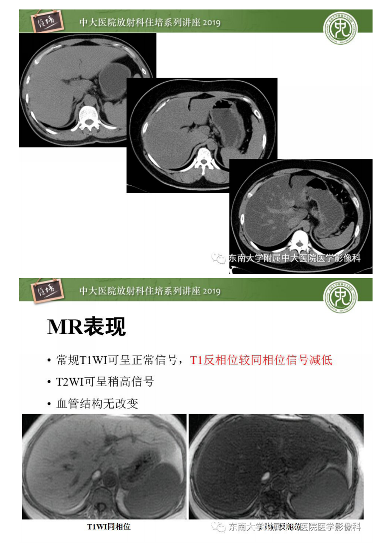 20200211_1【中大放射住培系列讲座】肝脏弥漫性病变影像表现.pdf 第5页