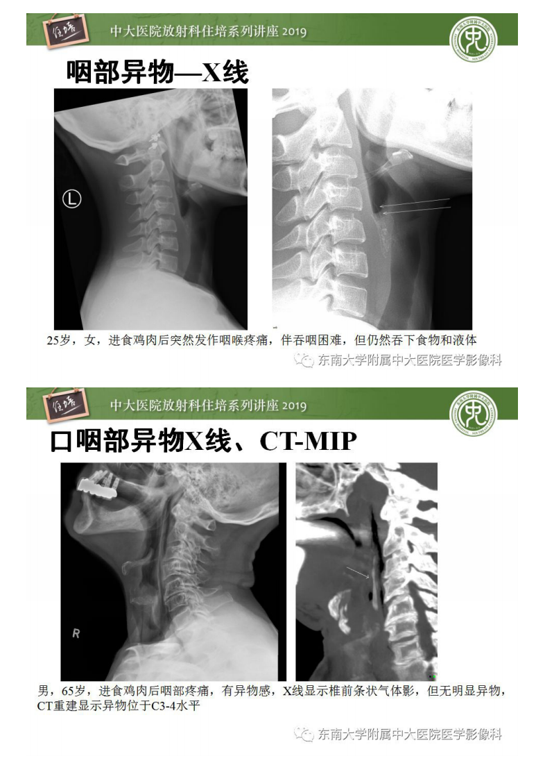 20190316_1【中大放射住培系列讲座第53期】口咽部异物及感染性病变的影像诊断.pdf 第5页