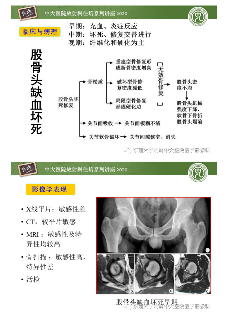 20200509_1【中大放射住培系列讲座】骨缺血坏死性病变的影像学特征.pdf 第5页