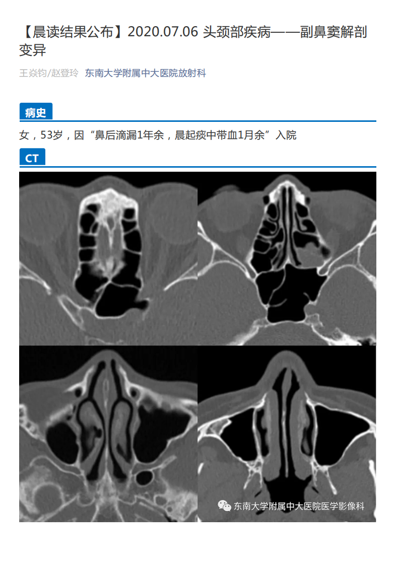 20200707_2【晨读结果公布】2020.07.06头颈部疾病——副鼻窦解剖变异.pdf 第1页
