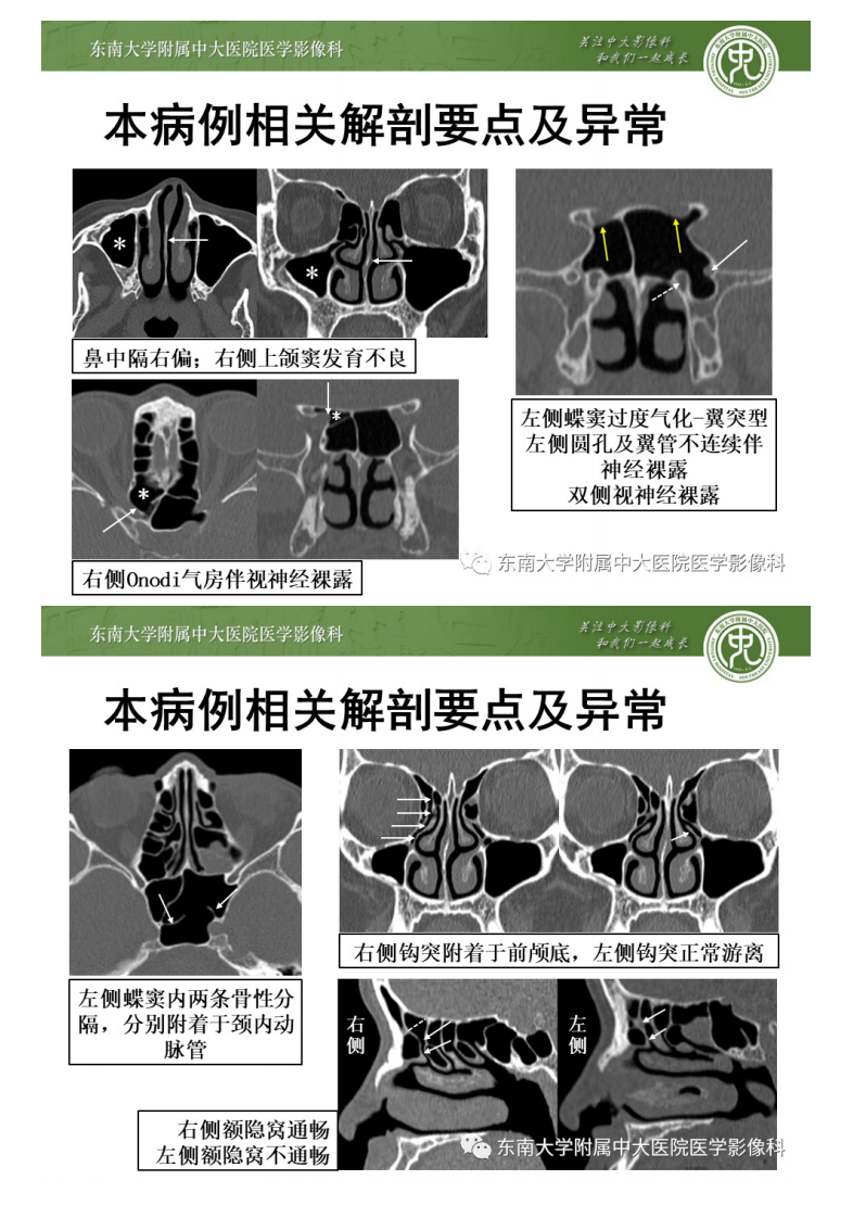20200707_2【晨读结果公布】2020.07.06头颈部疾病——副鼻窦解剖变异.pdf 第4页