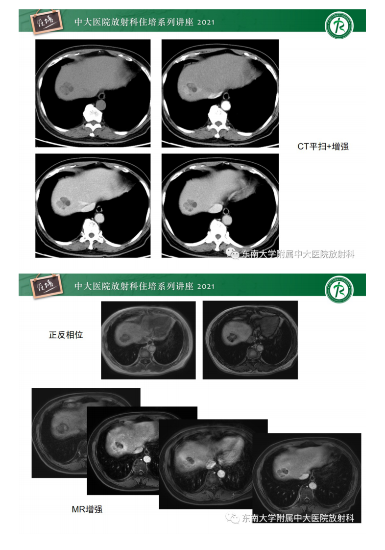 20210418_2【中大放射住培系列讲座】肝脏常见含脂病变.pdf 第4页
