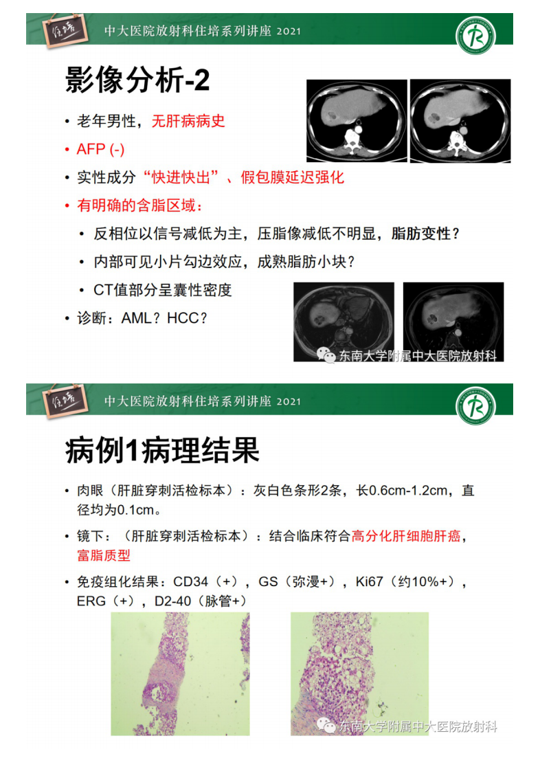 20210418_2【中大放射住培系列讲座】肝脏常见含脂病变.pdf 第5页