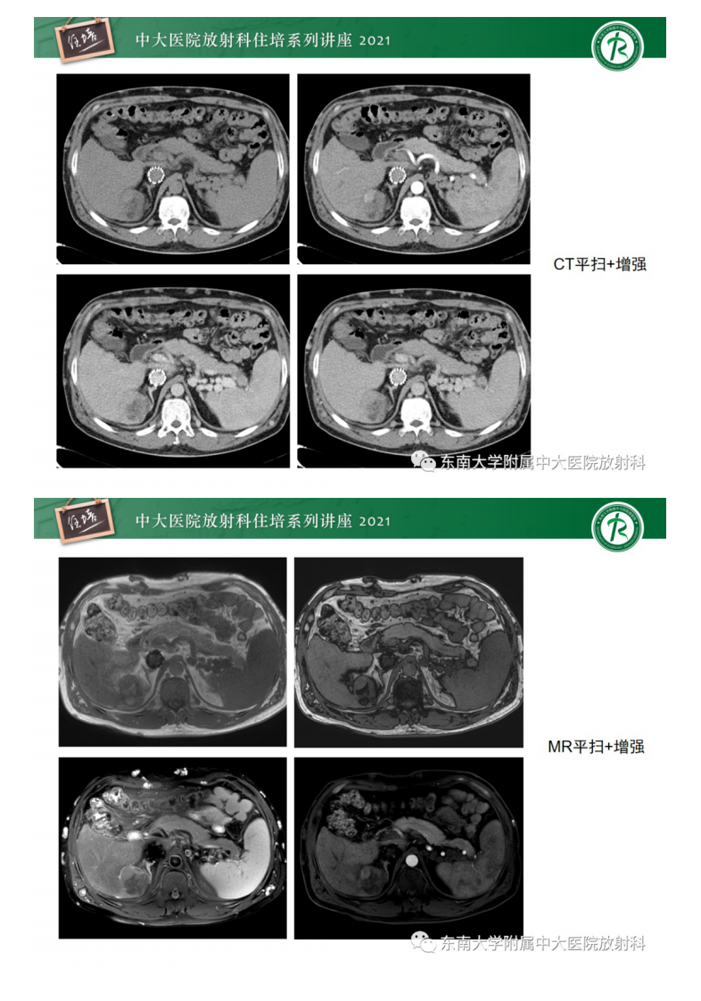 20210418_2【中大放射住培系列讲座】肝脏常见含脂病变.pdf 第2页