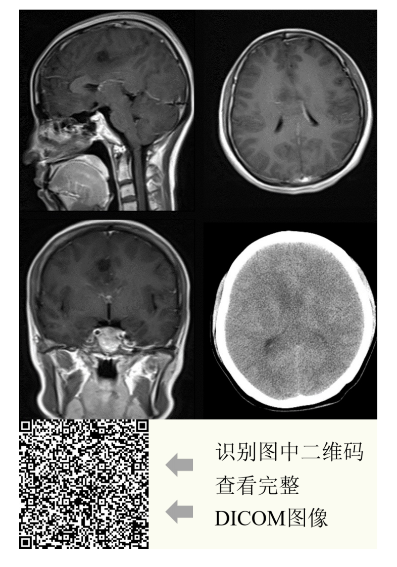20210608_2【晨读结果公布】2021.06.07神经系统疾病——病例1：间变型少突胶质细胞瘤；病例2：PCNSL；病例3：胼胝体急性梗死.pdf 第3页