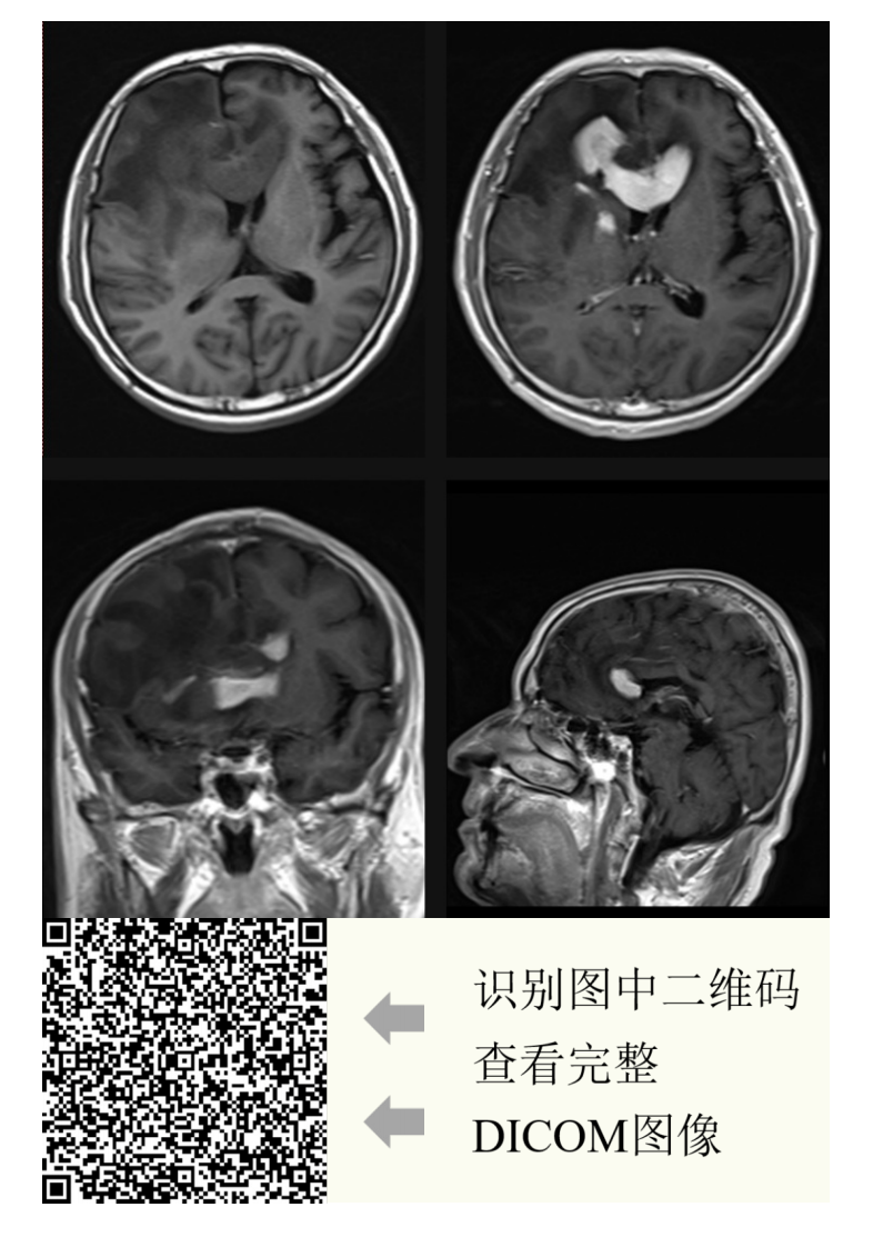 20210608_2【晨读结果公布】2021.06.07神经系统疾病——病例1：间变型少突胶质细胞瘤；病例2：PCNSL；病例3：胼胝体急性梗死.pdf 第5页