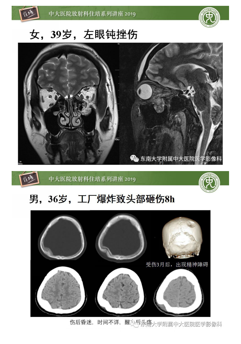 20190224_1【中大放射住培系列讲座第50期】成人颅脑损伤影像评估基本原则.pdf 第4页