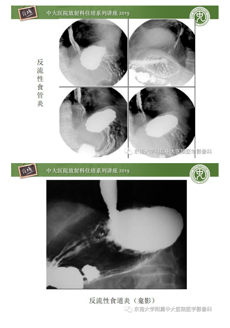 20190616_1【中大放射住培系列讲座第65期】食管常见疾病的诊断和鉴别诊断.pdf 第4页