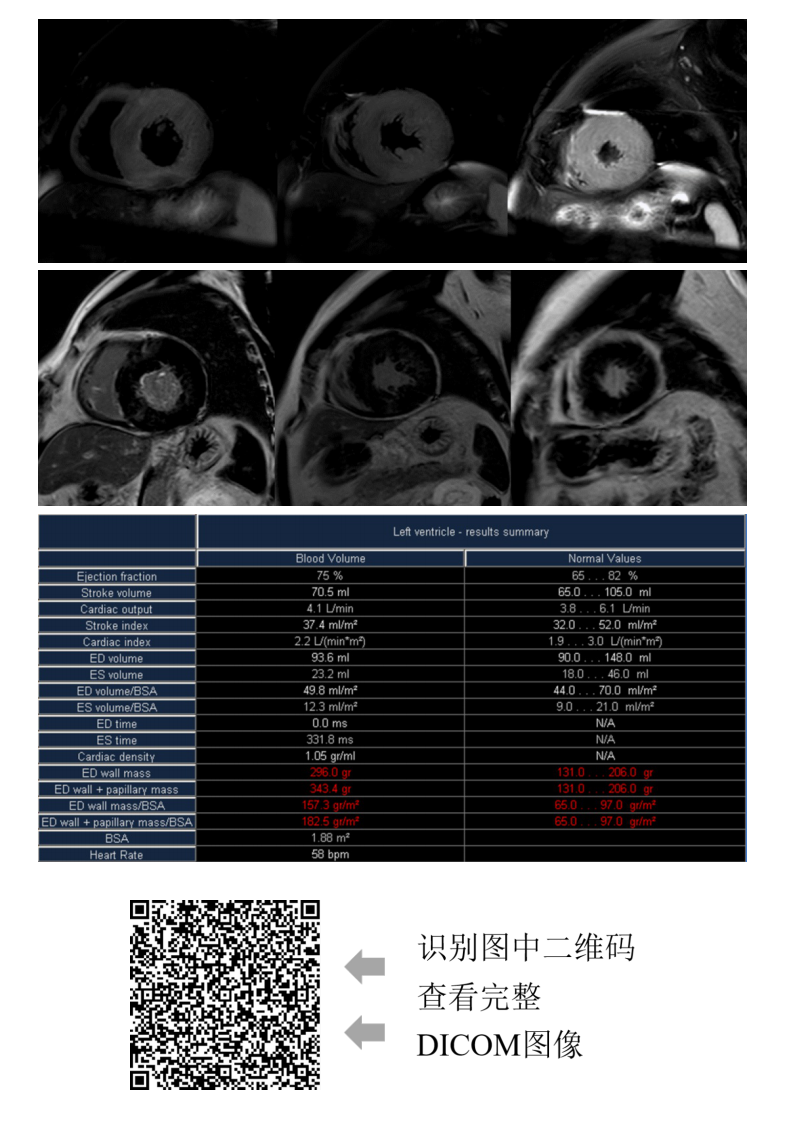20210601_3【晨读结果公布】2021.05.31循环系统疾病——病例1：肥厚型心肌病；病例2：主动脉瓣膜病变继发改变.pdf 第4页