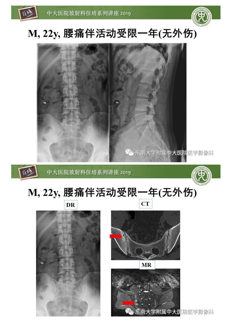 20200301_1【中大放射住培系列讲座】强直性脊柱炎影像学评估.pdf 第2页