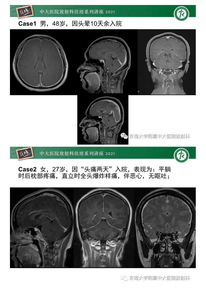 20210606_2【中大放射住培系列讲座】低颅压综合征的影像诊断要点.pdf 第2页