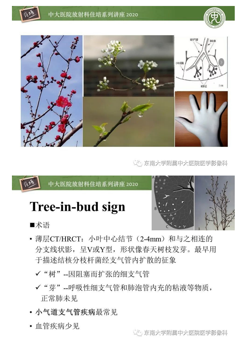 20200520_1【中大放射住培系列讲座】肺内常见影像征象解读（树芽征、指套征）.pdf 第2页