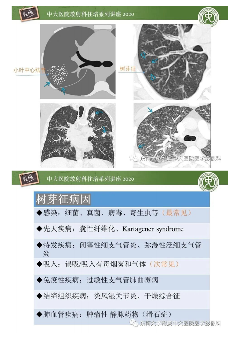 20200520_1【中大放射住培系列讲座】肺内常见影像征象解读（树芽征、指套征）.pdf 第5页