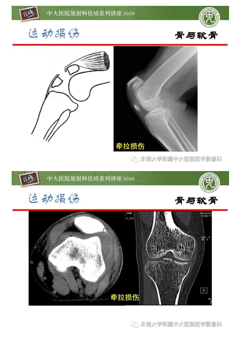 20200913_1【中大放射住培系列讲座】运动损伤的影像解读.pdf 第5页