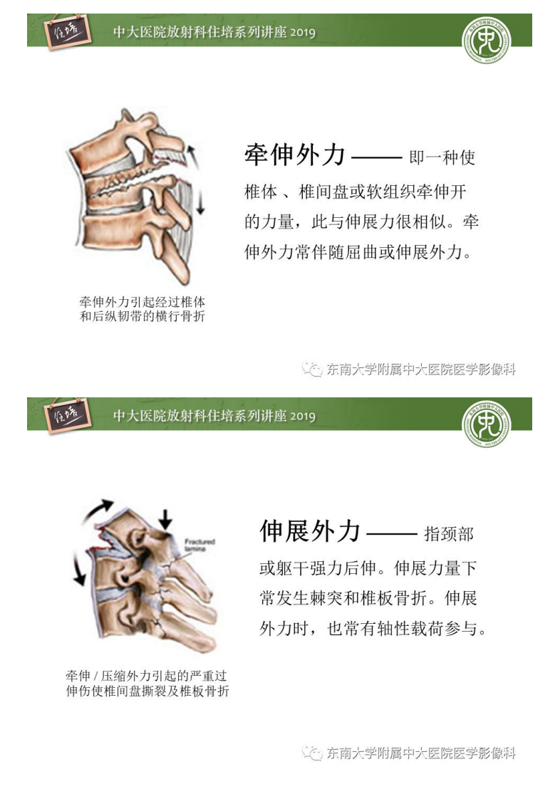 20190915_1【2019住培系列讲座第77期】脊柱创伤.pdf 第4页
