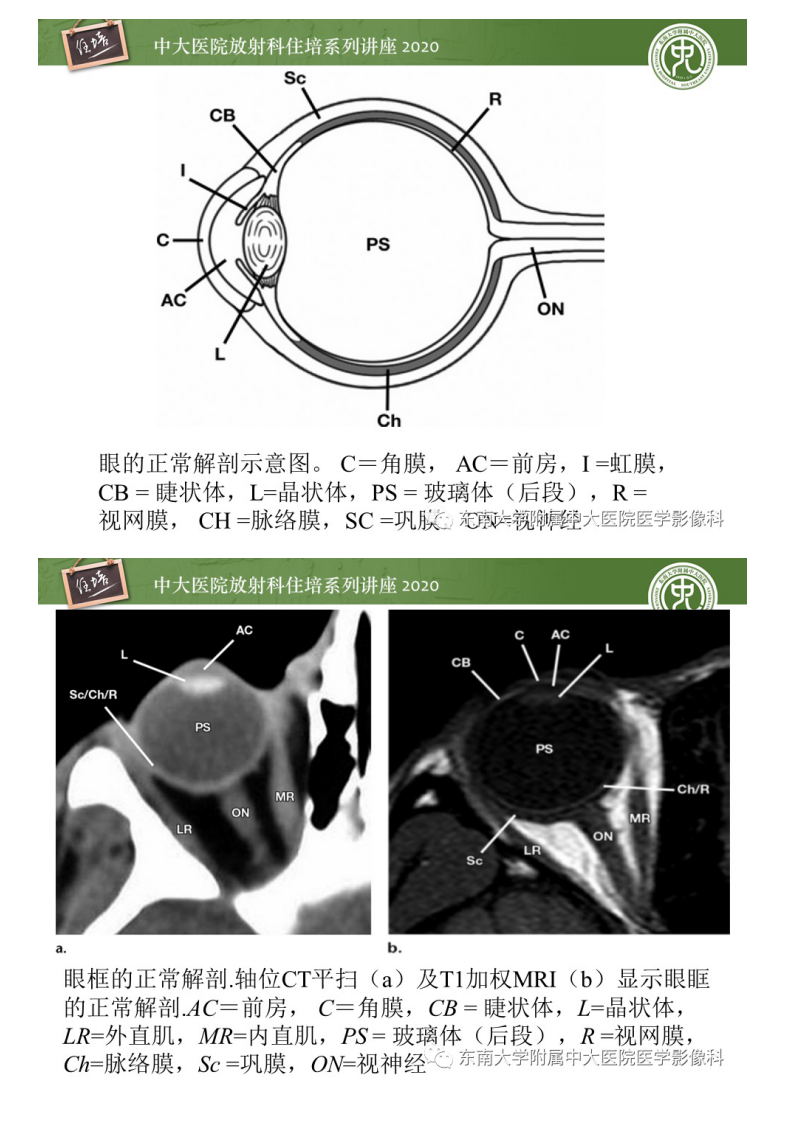 20201018_1【中大放射住培系列讲座】眼球外伤性病变的诊断和鉴别诊断.pdf 第3页