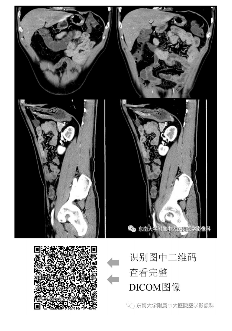 20210113_2【晨读结果公布】2021.01.13消化系统疾病——胃内异位胰腺.pdf 第4页