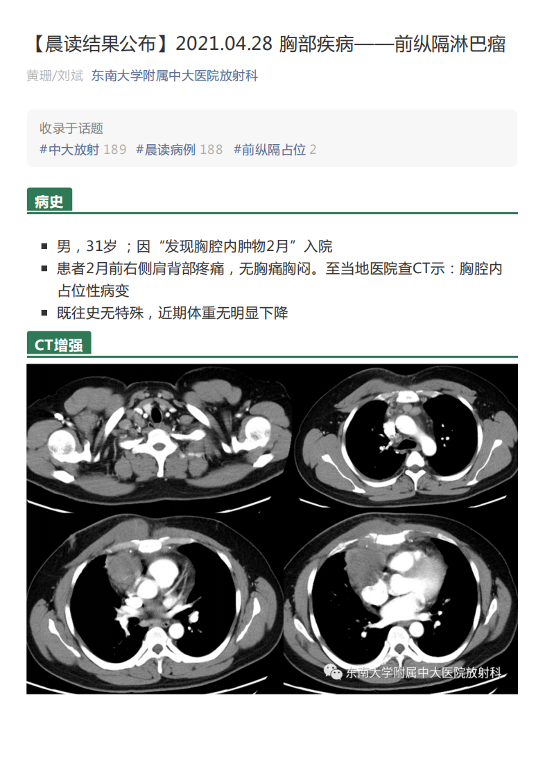 20210428_2【晨读结果公布】2021.04.28胸部疾病——前纵隔淋巴瘤.pdf 第1页