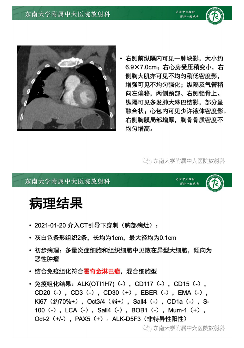 20210428_2【晨读结果公布】2021.04.28胸部疾病——前纵隔淋巴瘤.pdf 第4页