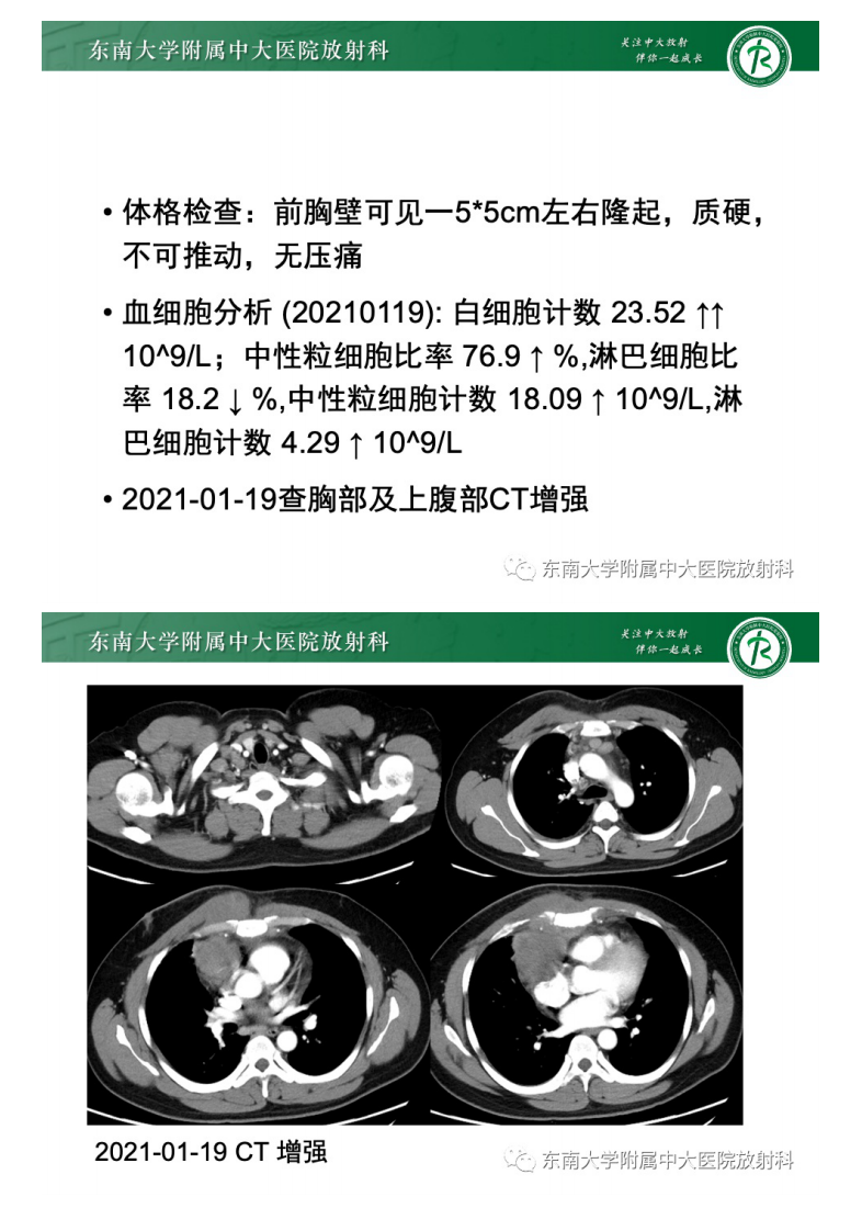 20210428_2【晨读结果公布】2021.04.28胸部疾病——前纵隔淋巴瘤.pdf 第3页