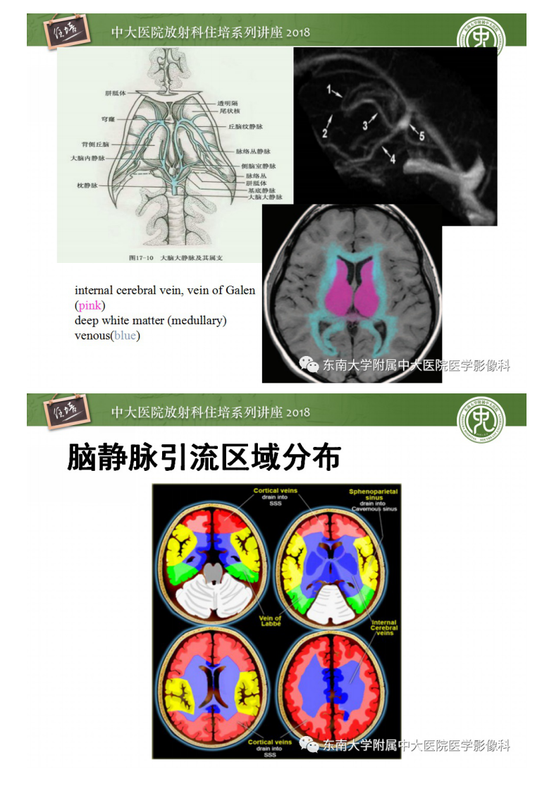 20200416_1【中大放射住培系列讲座】脑静脉血栓影像表现及图像解读误区.pdf 第4页