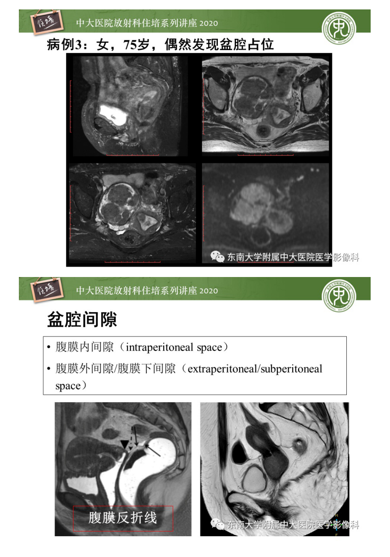 20200413_1【中大放射住培系列讲座】女性盆腔实性占位性病变定位分析.pdf 第3页