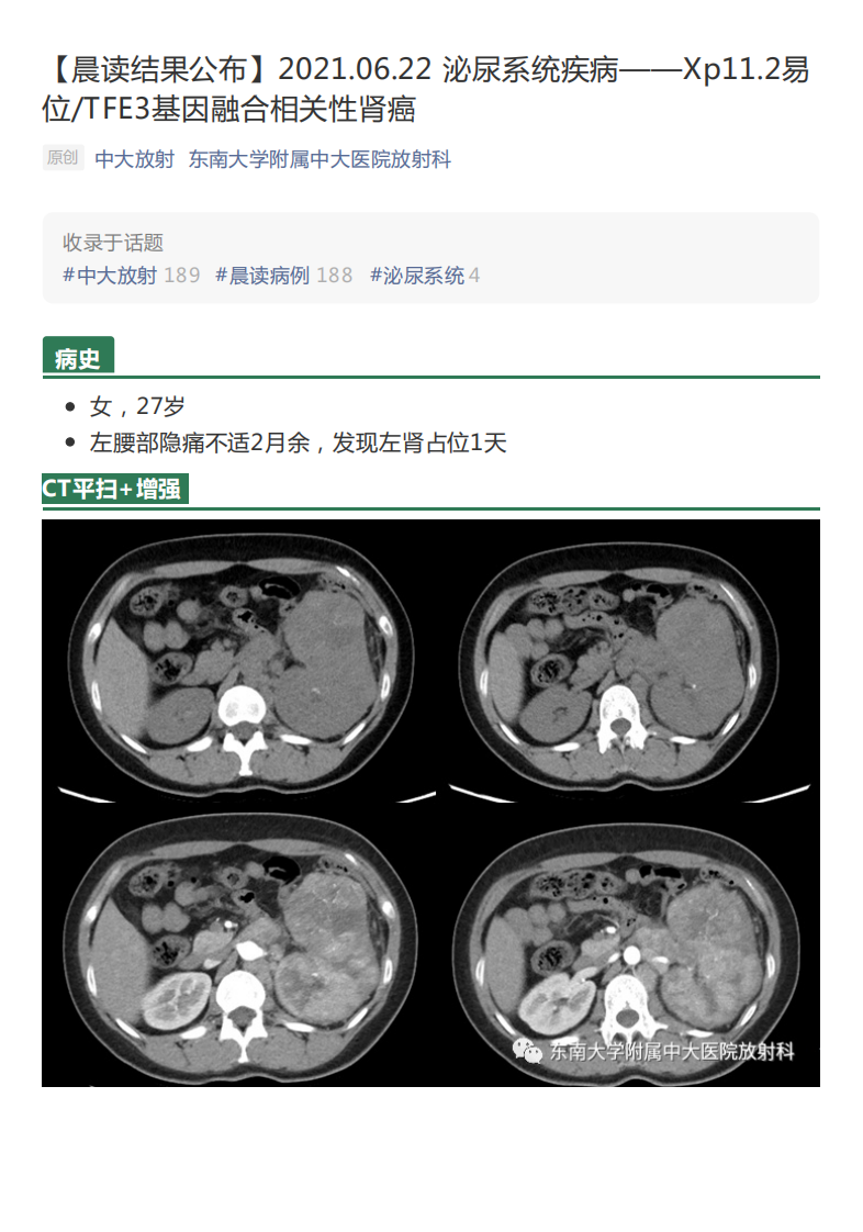 20210622_2【晨读结果公布】2021.06.22泌尿系统疾病——Xp11.2易位TFE3基因融合相关性肾癌.pdf 第1页
