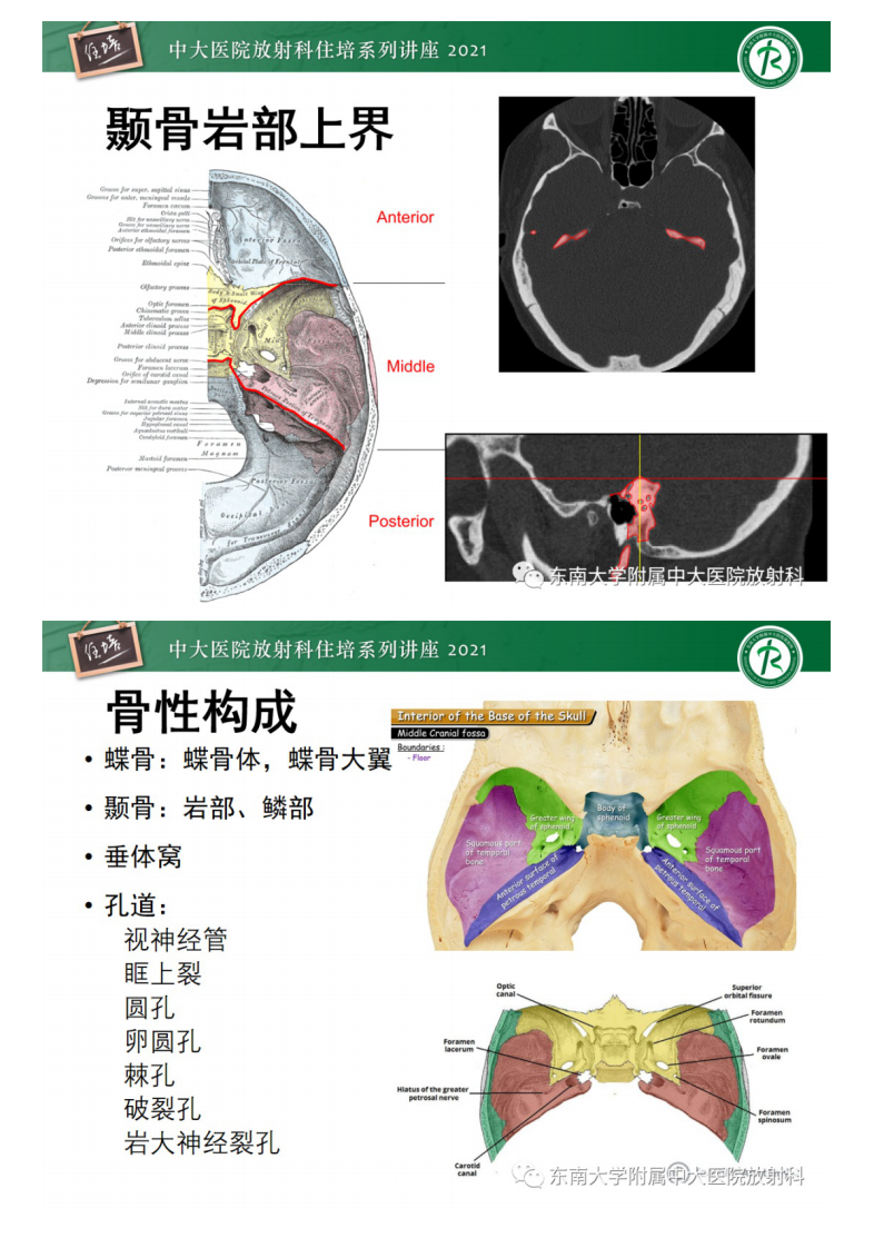 20210328_1【中大放射住培系列讲座】中颅窝底解剖结构及常见骨折征象.pdf 第3页